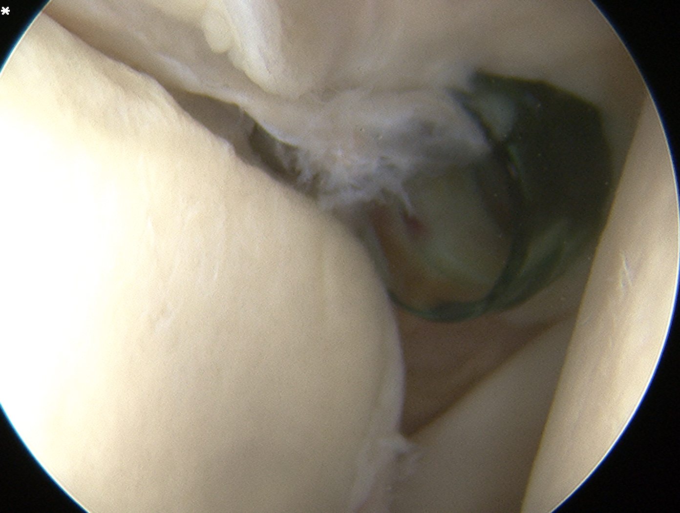 SLAP repair anterior portal